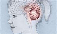 Chẩn đoán và điều trị u tiểu não ở trẻ em